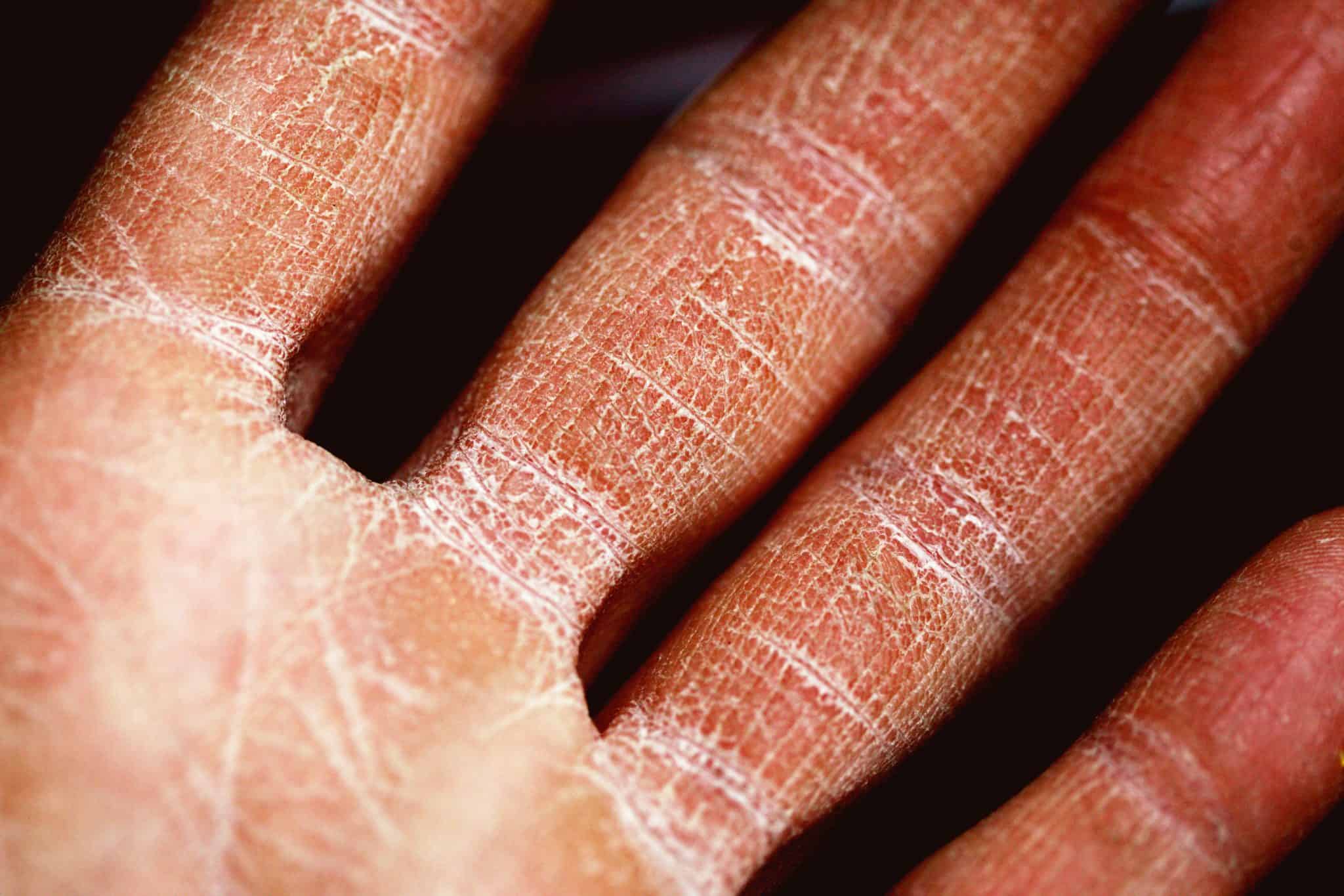 Why Does My Homemade Soap Dry My Skin? DIY products 101